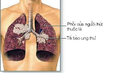 Ung thư phổi là một trong những loại ung thư nguy hiểm gây ra tỉ lệ tử vong cao.